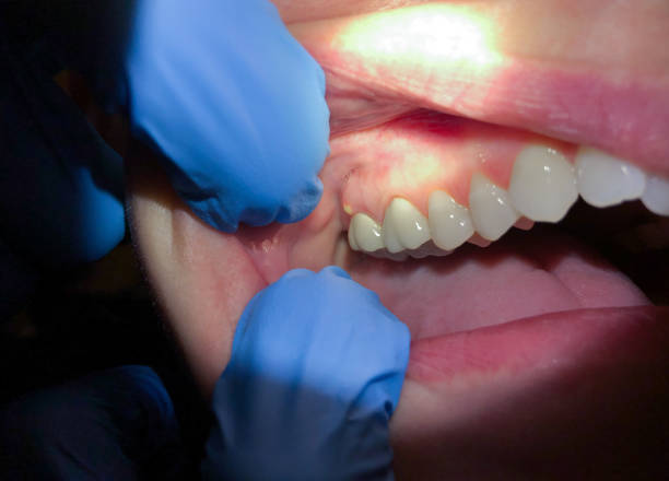 Best Emergency Treatment for Oral Infections in Chamberlain, SD